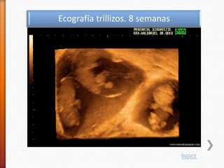 Ecografía trillizos. 8 semanas




                                 ÍNDICE
 