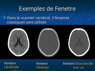 Exemples de Fenetre
Exemples de Fenetre
Fenetre
Fenetre
Cérébrale
Cérébrale
Fenetre
Fenetre
Osseuse
Osseuse
Fenetre
Fenetre Sous-durale
Sous-durale
W:350 L:90
W:350 L:90
 Dans le scanner cerebral, 3 fenetres
Dans le scanner cerebral, 3 fenetres
classiques sont utilisés
classiques sont utilisés
 