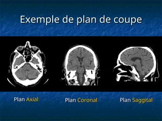 Exemple de plan de coupe
Exemple de plan de coupe
Plan
Plan Axial
Axial Plan
Plan Coronal
Coronal Plan
Plan Saggital
Saggital
 