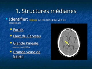 1. Structures médianes
1. Structures médianes
 Identifier:
Identifier: (
(cliquez
cliquez sur les noms pour voir les
sur les noms pour voir les
localitions)
localitions)
 Faux du Cerveau
Faux du Cerveau
 Glande Pineale
Glande Pineale
(souvent calcifiée)
(souvent calcifiée)
 Grande veine de
Grande veine de
Galien
Galien
 Fornix
Fornix
 