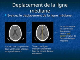Deplacement de la ligne
Deplacement de la ligne
médiane
médiane
 Evaluez le deplacement de la ligne médiane :
Evaluez le deplacement de la ligne médiane :
Trouvez une coupe où les
Trouvez une coupe où les
deux ventricules latéraux
deux ventricules latéraux
sont proéminents
sont proéminents
Tracez une ligne
Tracez une ligne
médiane joignant la
médiane joignant la
faux du cervea d’avant
faux du cervea d’avant
en arrière
en arrière
Le septum entre
Le septum entre
les ventricules
les ventricules
latéraux ne
latéraux ne
devrait
devrait pas
pas
devier
devier de plus de
de plus de
5mm de la ligne
5mm de la ligne
médiane
médiane
 