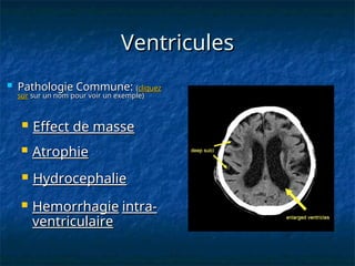  Pathologie Commune:
Pathologie Commune: (
(cliquez
cliquez
sur
sur sur un nom pour voir un exemple)
sur un nom pour voir un exemple)
 Hydrocephalie
Hydrocephalie
 Hemorrhagie
Hemorrhagie intra-
intra-
ventriculaire
ventriculaire
 Effect de masse
Effect de masse
 Atrophie
Atrophie
Ventricules
Ventricules
 