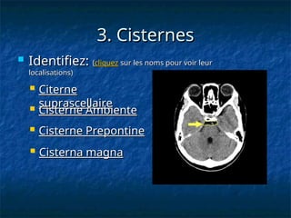 3.
3. Cisternes
Cisternes
 Identifiez:
Identifiez: (
(cliquez
cliquez sur les noms pour voir leur
sur les noms pour voir leur
localisations)
localisations)
 Citerne
Citerne
suprascellaire
suprascellaire
 Cisterne Ambiente
Cisterne Ambiente
 Cisterne Prepontine
Cisterne Prepontine
 Cisterna magna
Cisterna magna
 