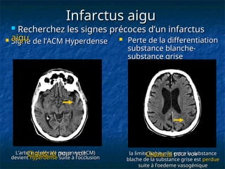 Infarctus aigu
Infarctus aigu
L’artere cérébrale moyenne (ACM)
L’artere cérébrale moyenne (ACM)
devient
devient hyperdense
hyperdense suite à l’occlusion
suite à l’occlusion
la limite habituelle entre la substance
la limite habituelle entre la substance
blache de la substance grise est
blache de la substance grise est perdue
perdue
suite à l’oedeme vasogénique
suite à l’oedeme vasogénique
 Signe de l’ACM Hyperdense
Signe de l’ACM Hyperdense
 Recherchez les signes précoces d’un infarctus
Recherchez les signes précoces d’un infarctus
aigu
aigu  Perte de la differentiation
Perte de la differentiation
substance blanche-
substance blanche-
substance grise
substance grise
Cliquez ici
Cliquez ici pour voir
pour voir Cliquez ici
Cliquez ici pour voir
pour voir
 