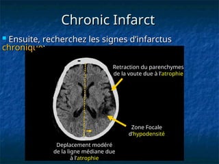 Chronic Infarct
Chronic Infarct
 Ensuite, recherchez les signes d’infarctus
Ensuite, recherchez les signes d’infarctus
chronique
chronique:
:
Deplacement modéré
de la ligne médiane due
à l’atrophie
Retraction du parenchymes
de la voute due à l’atrophie
Zone Focale
d’hypodensité
 