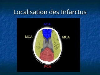 Localisation des Infarctus
Localisation des Infarctus
 