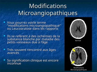 Modifications
Modifications
Microangiopathiques
Microangiopathiques
 Vous pourrez voirle terme
Vous pourrez voirle terme
“modifications microangiopathique”
“modifications microangiopathique”
ou Leucoaraïose dans les rapports
ou Leucoaraïose dans les rapports
 Ils se refèrent à des ischémies de la
Ils se refèrent à des ischémies de la
substance blanche par maladie des
substance blanche par maladie des
petits vaisseaux due à l’âge
petits vaisseaux due à l’âge
 Trés souvent rencontré aux âges
Trés souvent rencontré aux âges
avancés
avancés
 Sa signification clinique est encore
Sa signification clinique est encore
inconnue
inconnue
Modifications
Microangiopathiques
Normal
 