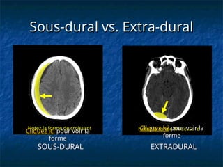 Sous-dural vs. Extra-dural
Sous-dural vs. Extra-dural
SOUS-DURAL
SOUS-DURAL EXTRADURAL
EXTRADURAL
Notez la forme de croissant
Notez la forme de croissant Notez la forme lenticulaire
Notez la forme lenticulaire
Cliquez ici
Cliquez ici pour voir la
pour voir la
forme
forme
Cliquez ici
Cliquez ici pour voir la
pour voir la
forme
forme
 
