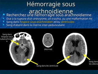 Hémorragie sous
Hémorragie sous
arachnoidienne
arachnoidienne
Sang dans
l’espace sous
subarachnoidie
n
Sang dans
les sillonsi
Sang dans les ventricule
 Recherchez une hémorragie sous arachnoidienne
Recherchez une hémorragie sous arachnoidienne
 Due à la rupture d’un anévrysme, un trauma, ou une malformation AV
Due à la rupture d’un anévrysme, un trauma, ou une malformation AV
 Sang dans l’
Sang dans l’espace sous-arachnoidien
espace sous-arachnoidien et/ou
et/ou ventricules
ventricules
 Sang d’abord dans la citerne inter-pedunculaire
Sang d’abord dans la citerne inter-pedunculaire
(Normal)
 