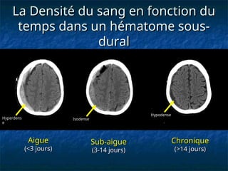 La Densité du sang en fonction du
La Densité du sang en fonction du
temps dans un hématome sous-
temps dans un hématome sous-
dural
dural
Aigue
Aigue
(<3 jours)
(<3 jours)
Sub-aigue
Sub-aigue
(3-14 jours)
(3-14 jours)
Chronique
Chronique
(>14 jours)
(>14 jours)
Hyperdens
e
Isodense
Hypodense
 