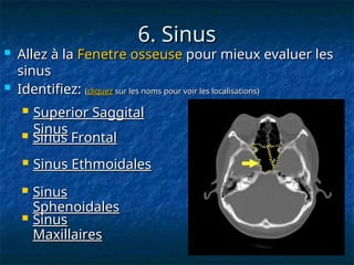 6. Sinus
6. Sinus
 Allez à la
Allez à la Fenetre osseuse
Fenetre osseuse pour mieux evaluer les
pour mieux evaluer les
sinus
sinus
 Identifiez:
Identifiez: (
(cliquez
cliquez sur les noms pour voir les localisations)
sur les noms pour voir les localisations)
 Sinus Ethmoidales
Sinus Ethmoidales
 Sinus
Sinus
Sphenoidales
Sphenoidales
 Superior Saggital
Superior Saggital
Sinus
Sinus
 Sinus Frontal
Sinus Frontal
 Sinus
Sinus
Maxillaires
Maxillaires
 