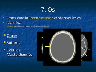 7. Os
7. Os
 Restez dans la
Restez dans la Fenetre osseuse
Fenetre osseuse et observez les os
et observez les os
 Identifiez:
Identifiez:
(
(cliquez
cliquez sur les noms pour voir les localisations)
sur les noms pour voir les localisations)
 Crane
Crane
 Sutures
Sutures
 Cellules
Cellules
Mastoidiennes
Mastoidiennes
 