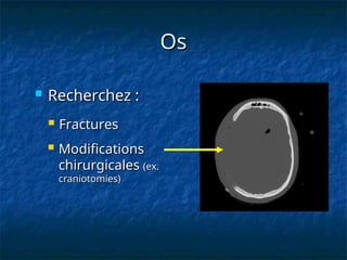Os
Os
 Recherchez :
Recherchez :
 Fractures
Fractures
 Modifications
Modifications
chirurgicales
chirurgicales (ex.
(ex.
craniotomies)
craniotomies)
 