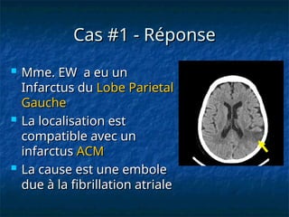 Cas #1 - Réponse
Cas #1 - Réponse
 Mme. EW a eu un
Mme. EW a eu un
Infarctus du
Infarctus du Lobe Parietal
Lobe Parietal
Gauche
Gauche
 La localisation est
La localisation est
compatible avec un
compatible avec un
infarctus
infarctus ACM
ACM
 La cause est une embole
La cause est une embole
due à la fibrillation atriale
due à la fibrillation atriale
 