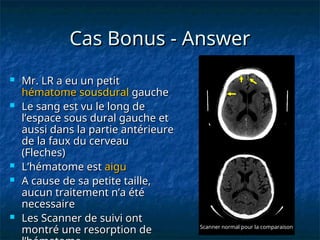 Cas Bonus - Answer
Cas Bonus - Answer
 Mr. LR a eu un petit
Mr. LR a eu un petit
hématome
hématome sousdural
sousdural gauche
gauche
 Le sang est vu le long de
Le sang est vu le long de
l’espace sous dural gauche et
l’espace sous dural gauche et
aussi dans la partie antérieure
aussi dans la partie antérieure
de la faux du cerveau
de la faux du cerveau
(Fleches)
(Fleches)
 L’hématome est
L’hématome est aigu
aigu
 A cause de sa petite taille,
A cause de sa petite taille,
aucun traitement n’a été
aucun traitement n’a été
necessaire
necessaire
 Les Scanner de suivi ont
Les Scanner de suivi ont
montré une resorption de
montré une resorption de Scanner normal pour la comparaison
Scanner normal pour la comparaison
 