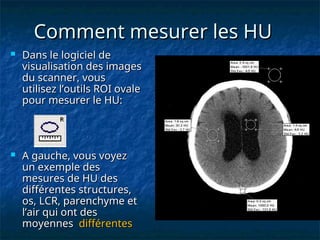 Comment mesurer les HU
Comment mesurer les HU
 Dans le logiciel de
Dans le logiciel de
visualisation des images
visualisation des images
du scanner, vous
du scanner, vous
utilisez l’outils ROI ovale
utilisez l’outils ROI ovale
pour mesurer le HU:
pour mesurer le HU:
 A gauche, vous voyez
A gauche, vous voyez
un exemple des
un exemple des
mesures de HU des
mesures de HU des
différentes structures,
différentes structures,
os, LCR, parenchyme et
os, LCR, parenchyme et
l’air qui ont des
l’air qui ont des
moyennes
moyennes différentes
différentes
 
