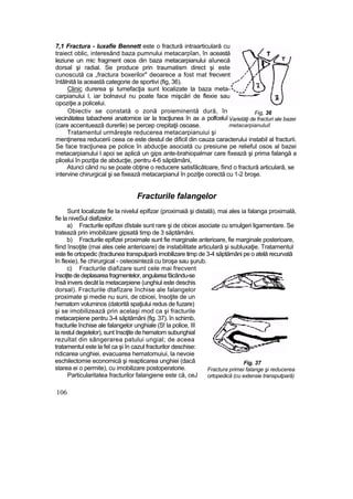 7,1 Fractura - luxafie Bennett este o fractură intraarticulară cu
traiect oblic, interesând baza pumnului metacarpîan, în această
leziune un mic fragment osos din baza metacarpianului aîunecă
dorsal şi radial. Se produce prin traumatism direct şi este
cunoscută ca „fractura boxerilor" deoarece a fost mat frecvent
întâlnită la această categorie de sportivi (fig, 36).
Clinic durerea şi tumefacţia sunt localizate la baza meta-
carpianului l, iar bolnavul nu poate face mişcări de flexie sau
opoziţie a policelui.
Obiectiv se constată o zonă proieminentă dură, în
vecinătatea tabacherei anatomice iar la tracţiunea în ax a polfceluî
(care accentuează durerile) se percep crepitaţii osoase.
Tratamentul urmăreşte reducerea metacarpianuiui şi
menţinerea reducerii ceea ce este destul de dificil din cauza caracterului instabil al fracturii.
Se face tracţiunea pe police în abducţie asociată cu presiune pe relieful osos al bazei
metacarpianului l apoi se aplică un gips ante-brahiopalmar care fixează şi prima falangă a
plicelui în poziţia de abducţie, pentru 4-6 săptămâni,
Atunci când nu se poate obţine o reducere satisfăcătoare, fiind o fractură articulară, se
intervine chirurgical şi se fixează metacarpianul în poziţie corectă cu 1-2 broşe.
Fracturile falangelor
Sunt localizate fie la nivelul epifizar (proximaiă şi distală), mai ales ia falanga proximală,
fie la niveSul diafizelor.
a) Fracturile epifizei dîstale sunt rare şi de obicei asociate cu smulgeri ligamentare. Se
tratează prin imobilizare gipsată timp de 3 săptămâni.
b) Fracturile epifizei proximale sunt fie marginale anterioare, fie marginale posterioare,
fiind însoţite (mai ales cele anterioare) de instabilitate articulară şi subluxaţie. Tratamentul
este fie ortopedic (tractiunea transpulpară imobilizare timp de 3-4 săptămâni pe o atelă recurvată
în flexie), fie chirurgical - osteosinteză cu broşa sau şurub.
c) Fracturile diafizare sunt cele mai frecvent
însoţitededeplasareafragmentelor,angulareafăcându-se
însă invers decât la metacarpiene (unghiul este deschis
dorsal). Fracturile dtafîzare închise ale falangelor
proximate şi medie nu suni, de obicei, însoţite de un
hematom voluminos (datorită spaţiului redus de fuzare)
şi se imobilizează prin acelaşi mod ca şi fracturile
metacarpiene pentru 3-4 săptămâni (fig. 37). în schimb,
fracturile închise ale falangelor unghiale (S! la police, III
la restul degetelor), sunt însoţite de hematom subunghial
rezultat din sângerarea patului ungial; de aceea
tratamentul este la fel ca şi în cazul fracturilor deschise:
ridicarea unghiei, evacuarea hematomuiui, la nevoie
eschilectomie economică şi reapticarea unghiei (dacă
starea ei o permite), cu imobilizare postoperatorie.
Particularitatea fracturilor falangiene este că, ceJ
106
Fig, 36
Varietăţi de fracturi ale bazei
metacarpianuluil
Fig. 37
Fractura primei falange şi reducerea
ortopedică (cu extensie transputpară)
 