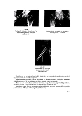 Fig.8
Radiografie de fractură de col femural cu
impactare posterioară tip Bohler
(şi Graden t).
Radiografie de fractură de cot femural cu
mare deplasare ~ Garden IV
F/g. 10
Osteosinteza cu 2 şuruburi
paralele pentru fracturi
mediocervicate
Mobilizarea cu cârjele se face la 2-3 săptămâni cu interdicţia de a călca pe membrul
respectiv minimum 4 luni de la operaţie.
Este preferabil ca Ia cea. 2 luni de fa operaţie, să se facâ un control scsntigrafîc al soldului
şi dacă sunt semne de consolidare menţinem această fixare cu şuruburi.
Dacă nu sunt semne de consolidare, vom înlocui capul femural cu o proteză bipolară sau
în cel mai rău caz, cu o proteză cervico-cefaiîcă de tip Moore, (flg. 11)
La bolnavii foarte vârstnici cu osteoporoză severă trebuie ca aceste proteze să fie cimentate
pentru a nu se „înfunda" în femur (proteza Thomson).
117
 