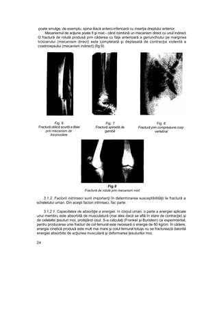 poate smulge, de exemplu, spina iliacă antero-inferioară cu inserţia dreptului anterior.
Mecanismul de acţiune poate fi şi mixt - când combină un mecanism direct cu unul indirect.
O fractură de rotulă produsă prin căderea cu faţa anterioară a genunchiului pe marginea
trotoarului (mecanism direct) este completată şi deplasată de contracţia violentă a
cvadricepsului (mecanism indirect) (fig.9).
Fig, 6
Fractură oblică scurtă a tibiei
prin mecanism de
înconvoîere
Fig. 7
Fractură spiroidă de
gambă
Fig. 8
Fractură prin compresiune corp
vertebral
Fig.9
Fractură de rotulă prin mecanism mixt
3,1.2. Factorii intrinseci sunt importanţi în determinarea susceptibilităţii la fractură a
scheletului uman. Din aceşti factori intrinseci, fac parte:
3.1,2.1. Capacitatea de absorbţie a energiei. !n corpul uman, o parte a energiei aplicate
unui membru este absorbită de musculatură (mai ales dacă se află în stare de contracţie) şi
de celelalte ţesuturi moi, protejând osul. S-a calculaţi (FrankeI şi Buristein) ca experimental,
pentru producerea unei fracturi de col femural este necesară o energie de 60 kg/cm. In cădere,
energia cinetică produsă este mult mai mare şi colul femural totuşs nu se fracturează datorită
energiei absorbite de acţiunea musculară şi deformarea ţesuturilor moi,
24
 