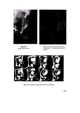 Fig.H-C
Oblică iiiacă sau alară
Fig. 13 Fracturi ale peretelui posterior al
acetabulului: -reconstrucţie tridimen-
sională
Fig. 12 Tomografia computerizată în fracturile acetabulare
213
 