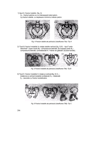 1) lipul A: fracturi stabile: (fig, 4)
A1 - fracturi pelvine ce nu interesează inelul pelvin,
A2-fracturi stabile, cu deplasare minimă a inelului pelvin.
Fig. 4 Fracturi stabile ale pelvisului (clasificarea Tiie) -Tip A
2) Tipul 8: fracturi instabile în rotaţie stabile vertical (fig. 5) B, - tipul "carte
deschisă": (open book) Bj - compresiune laterală, de aceeaşi parte B3 -
compresiune laterală, contralaterală în: "mâner de găleată" (bucket handte).
Fig. 5 Fracturi instabile ale pelvisului (clasificarea Ttle)- Tip B
3} Tipul C: fracturi instabile în rotaţie şi vertical ţfig. 6) C1 -
rotaţionai şi vertical instabile (unilateral) C2 - bilaterală
Cs - asociate cu fracturi acetabulare.
206
Fig. 6 Fracturi instabile aie pelvisului (clasificarea Til&)- Tip C
 