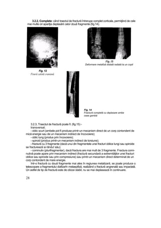 3.2.2, Complete: când traectul de fractură întrerupe complet corticala, permiţând de cele
mai multe ori apariţia deplasării celor două fragmente (fig.14).
Fig. 1$
Deformare metafiză distală radiată ta un copil
Fig. 12
Fisură calotă craniană
Fig. 14
Fractură completă cu deplasare ambe
oase gambă
3.2.3, Traectut de fractură poate fi: (fig.15) -
transversal;
- oblic scurt (ambele pot fi produse printr-un mecanism direct de un corp contondent de
mică energie sau de un mecanism indirect de încovoiere);
- oblic lung (produs prin încovoiere);
- spiroid (produs printr-un mecanism indirect de torsiune);
- fractură cu 3 fragmente (dacă unui din fragmentele unei fracturi oblice lungi sau spiroide
se fracturează ia rându! său);
- cominutiv (plurifragmentar), dacă fractura are mai mult de 3 fragmente. Fractura comi-
nutivă poate apare prin mecanism indirect (fractură secundară a extremităţilor unei fracturi
oblice sau spiroide sau prin compresiune) sau printr-un mecanism direct determinat de un
corp contondent de mare energie.
într-o fractură cu două fragmente mai ales în regiunea metalizară, se poate produce o
telescopare a fragmentului diafizarîn metaepifiză, realizând o fractură angrenată sau impactată.
Un astfel de tip de fractură este de obicei stabil, nu se mai deplasează In continuare.
28
 