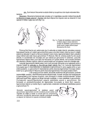 gie,. Sunt leziuni frecvente la aduliui tânăr şi ocupă locui doi după entorsele tibio-
tarsiene.
Mecanism. Mecanismul lezional este complex şi în majoritatea cazurilor indirect &Ja,djucBi
cu flexiune şi rotaţie externă.^, Sambei este tipul obişnuit de mişcare care se observă în mod
special în fotbal, rugby sau schi (fig.1-a).
Fig. 1 a. Poziţia d& stabilitate a genunchiului
în flexie-vatgum rotase externă b.
Poziţia de stabilitate a genunchiului în
f/exle-vantm rotaţie internă (după
Bousquet şi De Jour).
Picioruş fiind fixat ta sol, şoldul este dus în adducţie şi rotaţie internă, greutatea corpului
basculează înainte şi în afară, genunchiul fiind supus unui efort violent, tibia se duce în rotaţi©
externă şi abducţie In raport cu femurul orientat în sens invers, ligamentul latera! intern preluând
singur efortul care este impus genunchiului Tn flexiune. Mai rar, entorsa poate fi şi de cauză
directă, în accidentele de circulaţie prin şoc lateral pe genunchiul în extensie. Leziunile
ligamentului lateral intern sunt cele mai frecvente şi în grade diferite, de la simplă întindere
sau desirare a fibrelor mijSocii, până ia ruptură totaia sau smulgerea uneia din inserţiile sale.
Leziunile îigamentuSui lateral extern sunt mult mai puţin frecvente şi se realizează printr-o
mişcare forţată de adducţjg cu, fle,xj,Mn,eşj fotaţj^ iolemă (fsg.1~b). Leziunile ligamentelor
încrucişate apar în traumatismele cu deplasare a genunchiului în sens sagital printr-un şoc
antero-posterior, cu genunchiul în hiperextensie pentru leziunea ligamentului încrucişai antero-
extern şi cu genunchiul în flexiune pentru leziunea ligamentului încrucişat postero-intern.
|. Din acest punct de vedere, structurile anatomice ale genunchiului: portante
(extremităţile osoase), rfea/Wîecare(meniscurile)sinoviala, bursele seroase.cfe^xareţcapsula
şi ligamentele) şi de mişcare (muşchii), care formează o unitate morfofuncţională "echipa
a/#cu/arâ"dupăTriliat, asigură pe lângă osimplă mobilitate, o mare stabilitate a genunchiului,
Formaţiunite capsulO'ligamentare asigură stabilitatea pasivă a genunchiului. Ele
formează un pivotcenlm/consiituit din ligamentele încrucişate şi două Muri capsuîo-
ligamentare latera! şi medial (fig.2). Ligamentele colaterale controlează stabilitatea pasivă
a genunchiului Tn
Fig. 2
Structurile capsulo-iigarnentare de stabilizare pasivă ale
genunchiului; ligamentele incricîte constituie pivotul central, axa
mişcărilor de rotaţie şt menţin un anumit grad de compresiune
articulară; formaţiunile tigamentare laterale controlează varusttt
şi vaigusul, Iar împreună cu capsula controlează rotaţiile.
222
.
 