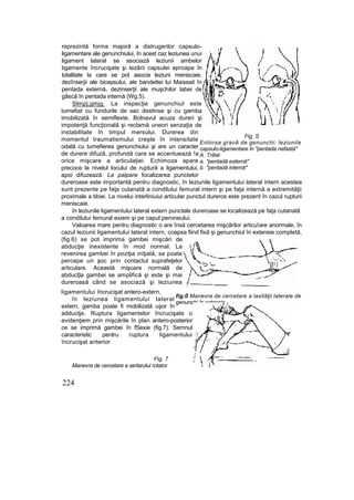 reprezintă forma majoră a distrugerilor capsulo-
ligamentare ale genunchiului, în acest caz leziunea unui
ligament lateral se asociază leziunii ambelor
ligamente încrucişate şi lezării capsulei aproape în
totalitate la care se pot asocia leziuni meniscaie,
dezînserjii ale bicepsului, ale bandettei lui Maissait în
pentada externă, dezinserţii ale muşchilor labei de
gâscă în pentada internă (Wg.5).
Slmp|,gmjg. La inspecţie genunchiul este
tumefiat cu fundurile de sac destinse şi cu gamba
imobilizată în semiflexte. Bolnavul acuza dureri şi
impotenţă funcţională şi reclamă uneori senzaţia de
instabilitate în timpul mersului. Durerea din
momentul traumatismului creşte în intensitate
odată cu tumefierea genunchiului şi are un caracter
de durere difuză, profundă care se accentuează !a
orice mişcare a articulaţiei. Echimoza apare
precoce la nivelul locului de ruptură a ligamentului,
apoi difuzează. La palpare focalizarea punctelor
dureroase este importantă pentru diagnostic, în leziunile ligamentului lateral intern acestea
sunt prezente pe faţa cutanată a condilului femural intern şi pe faţa internă a extremităţii
proximale a tibiei. La nivelui interliniuiui articular punctul dureros este prezent în cazul rupturii
meniscaie.
în leziunile ligamentului lateral extern punctele dureroase se localizează pe faţa cutanată
a condilului femural exiem şi pe capul peroneului.
Valoarea mare pentru diagnostic o are însă cercetarea mişcărilor articu!are anormale, în
cazul leziunii ligamentului lateral intern, coapsa fiind fixă şi genunchiul în extensie completă,
(fig.6) se pot imprima gambei mişcări de
abducţie inexistente în mod normal. La
revenirea gambei în poziţia iniţială, se poate
percepe un şoc prin contactul suprafeţelor
articulare. Această mişcare normală de
abducţla gambei se amplifică şi este şi mai
dureroasă când se asociază şi leziunea
ligamentului încrucişat antero-extern,
în leziunea ligamentului lateral
extern, gamba poate fi mobilizată uşor în
adductje. Ruptura ligamentelor încrucişate o
evidenţiem prin mişcările în plan antero-posterior
ce se imprimă gambei în fSexie (fig.7). Semnul
caracteristic pentru ruptura ligamentului
încrucişat anterior
Fig. 7
Manevra de cercetare a sertarului rotator
224
Fig. S
Entorsa gravă de genunchi; leziunile
capsulo-ligamentare în "pentada nefastă"
A. Trillat
a. "pentadă externă"
b. "pentadă internă"
fig.0 Manevra de cercetare a laxităţii laterale de
genunchi în extensie
 