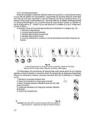 3.2.5. Leziunile tegumentare
Anatomia patologică a fracturilor diafizare trebuie să cuprindă nu numai leziunile osoase
ci şi pe cele ale părţilor moi înconjurătoare. Tegumentele pot prezenta soluţii de continuitate
mai mult sau mai puţin importante în fractură deschisă, dar ele pot prezenta leziuni şi In
fractură închisă (după scoată elveţiană AO - denumită astfel de Ia iniţialele arbeîtsegmeinshaft
fur Osteosynthesefragen), Ea a codificat leziunile tegumentare închise cu iniţialele IC
(de la l-lntegumenf şi C - "closed") iar pe cele deschise cu iniţialele IO (l de ia "integument"
şi O de Ia "open"),
în fracturile închise (IC) leziunile tegumentare pot fi clasificate în 5 categorii (fig. 18):
1. fără leziuni tegumentare;
2. contuzie tegumentară localizată;
: 3. decolare tegumentară circumscrisă;
f 4. decolare tegumentară întinsă;
i 5. necroză cutanată prin contuzie cu risc de deschidere secundară a focarului de
' fractură.
Fig, 18
Leziunile tegumentare în fracturile închise şi deschise; clasificare AO (după
Manual Internai Fixation-Multer Allgower, Schneider, Witlenegger)
3.2.6.Musculatura din jurul focarului de fractură poate suferi diverse leziuni fie prin acţiunea
agentului vutnerant (fractură cu mecanism direct), fie determinate de deplasarea fragmentelor
fracturii (în mecanismul indirect). Leziunile musculare (MT) pot fi clasificate în 5 categorii
•g.19):
1. fără leziuni musculare evidente clinic; ^
2. leziuni circumscrise la un singur grup muscular; ij^jj'
3. leziuni musculare extensive interesând două sau mai multe
grupe musculare;
4. avulsia sau pierderea unui întreg grup muscular, dilacerări
tendinoase;
5. sindrom de compartiment.
V Fig. 19
Leziunile musculare (MT) şi vasculo-nervoase (NU) ce pot apare în
cadrul fracturilor - clasificarea AO (Manual Internat Fixation)
23
 