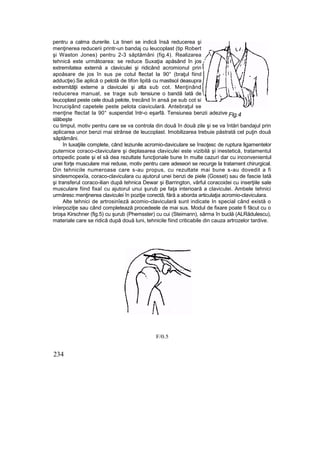 pentru a calma durerile. La tineri se indică însă reducerea şi
menţinerea reducerii printr-un bandaj cu leucoplast (tip Robert
şi Waston Jones) pentru 2-3 săptămâni (fig.4). Realizarea
tehnică este următoarea: se reduce Suxaţia apăsând în jos
extremitatea externă a claviculei şi ridicând acromionul prin
apoăsare de jos în sus pe cotul flectat la 90° (braţul fiind
adducţie).Se aplică o pelotă de tifon lipită cu mastisol deasupra
extremităţii externe a claviculei şi alta sub cot. Menţinând
reducerea manual, se trage sub tensiune o bandă Iată de
leucoplast peste cele două pelote, trecând în ansă pe sub cot si
încrucişând capetele peste pelota ciaviculară. Antebraţul se
menţine ftectat la 90° suspendat într-o eşarfă. Tensiunea benzii adezive
slăbeşte
cu timpul, motiv pentru care se va controla din două în două zile şi se va întări bandajul prin
aplicarea unor benzi rnai strânse de leucoplast. Imobilizarea trebuie păstrată cel puţin două
săptămâni.
în luxaţiile complete, când leziunile acromio-daviculare se însoţesc de ruptura ligamentelor
puternice coraco-claviculare şi deplasarea claviculei este vizibilă şi inestetică, tratamentul
ortopedic poate şi el să dea rezultate funcţionale bune In multe cazuri dar cu inconvenientul
unei forţe musculare mai reduse, motiv pentru care adeseori se recurge la tratament chirurgical.
Din tehnicile numeroase care s-au propus, cu rezultate mai bune s-au dovedit a fi
sindesmopexîa, coraco-claviculara cu ajutorul unei benzi de piele (Gosset) sau de fascie Iată
şi transferul coraco-ilian după tehnica Dewar şi Barrington, vârful coracoidei cu inserţiile sale
musculare fiind fixaî cu ajutorul unui şurub pe faţa interioară a claviculei. Ambele tehnici
urmăresc menţinerea claviculei în poziţie corectă, fără a aborda articulaţia acromio-claviculara.
Alte tehnici de artrosinîeză acomio-claviculară sunt indicate In special când există o
inîerpoziţie sau când completează procedeele de mai sus. Modul de fixare poate fi făcut cu o
broşa Kirschner (fig.5) cu şurub (Phemsster) cu cui (Steimann), sârma în buclă (ALRădulescu),
materiale care se ridică după două luni, tehnicile fiind criticabile din cauza artrozelor tardive.
234
F/0.5
Flg.4
 