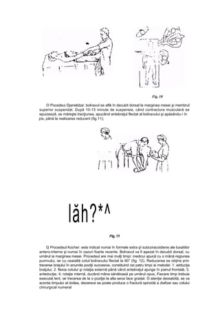Fig, 10
O Pocedeui Djanelidze: bolnavul se află în decubit dorsal la marginea mesei şi membrul
superior suspendat. După 10-15 minute de suspensie, când contractura musculară se
epuizează, se măreşte tracţiunea, apucând antebraţul flectat al bolnavului şi apăsându-i în
jos, până la realizarea reducerii (fig.11);
lăh?*^
Fig, 11
Q Procedeul Kocher: este indicat numai în formele extra şî subcoracoidiene ale luxatiilor
antero-interne şi numai în cazuri foarte recente. Bolnavul va fi aşezat în decubit dorsal, cu
umărul ia marginea mesei. Procedeul are mai mulţi timpi: medicui apucă cu o mână regiunea
pumnului, iar cu ceaialtă cotul bolnavului flectat la 90° (fig. 12). Reducerea se obţine prin
trecerea braţului în anumite poziţii succesive, constituind cei patru timpi ai metodei: 1. adducţia
braţului; 2. flexia cotului şi rotaţia externă până când antebraţul ajunge în pianul frontală; 3.
anteducţie; 4; rotaţie internă, ducând mâna sănătoasă pe umărul opus, Fiecare timp trebuie
executat lent, iar trecerea de la o poziţie la alta seva îace gradat. O atenţie deosebită, se va
acorda timpului al doilea, deoarece se poate produce o fractură spiroidă a diafizei sau colului
chirurgical numeral
 