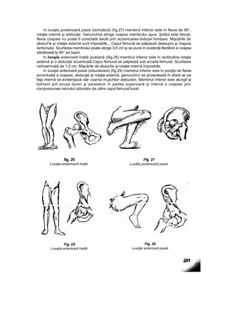 în luxaţia posterioară joasă (ischiatică) (fig.27) membrul inferior este în flexie de 90°,
rotaţie internă şi adducţie. Genunchiul atinge coapsa membrului opus. Şoldul este blocat,
flexia coapsei nu poate fi corectată decât prin accentuarea lodozei lombare. Mişcările de
abducî'ie şi rotaţie externă sunt imposibile.,..Capul femural se palpează deasupra şi înapoia
ischionului. Scurtarea membrului poate atinge 3-5 cm şi se pune în evidenţă flectând si coapsa
sănătoasă la 90° pe bazin.
In luxajîa anterioară înaltă (pubiană )(fig.28) membrul inferior este în rectitudine rotaţie
externă şi o abducţie accentuată.Capui femural se palpează sub arcada femural. Scurtarea
neînsemnată de 1-2 cm. Mişcările de abducîie şi rotaţie internă imposibile,
în luxaţia anterioară joasă (obturatoare) (fig.29) membrul inferior este In poziţie de flexte
accentuată a coapsei, abducţie şt rotaţie externă; genunchru! se proiectează în afară iar pe
faţa internă se evidenţiază clar coarda muşchilor adductori. Membrul inferior este alungit şi
bolnavii pot acuza dureri şi parestezii în partea superioară şi internă a coapsei prin
compresiunea nervului obturator de către capul femural luxat.
fig, 26
Luxaţia posterioară înaită
Ffg. 27
Luxâfia posterioară joasă
Fig. £8
Luxaţia anterioară înaltă
Fig. 29
Luxaţia anterioară joasă
 