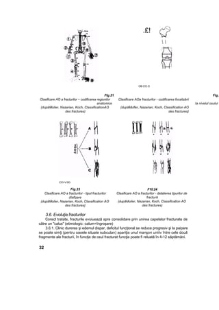 .£!
 
OB-CO.O
Flg.21 Fig.2
Clasificare AO a fracturilor ~ codificarea regiunilor Clasificare AOa fracturilor - codificarea focalizării
anatomice ta nivelul osului
(dupăMulier, Nazarian, Koch, ClassificationAO (dupăMufler, Nazarian, Koch, Classification AO
des fractures) des fractures}
CD-V3D
Fig.23
Clasificare AO a fracturilor - tipul fracturilor
dîafizare
(dupăMulier, Nazarian, Koch, Classification AO
des fractures}
F10.24
Clasificare AO a fracturilor - detalierea tipurilor de
fractură
(dupăMulier, Nazarian, Koch, Classification AO
des fractures)
3.6. Evoluţia fracturilor
Corect tratate, fracturile evoiuează spre consolidare prin unirea capetelor fracturate de
către un "calus" (etimologic: calum=îngroşare)
3.6.1. Clinic durerea şi edemul dispar, deficitul funcţional se reduce progresiv şi la paipare
se poate simţi (pentru oasele situate subcutan) apariţia unul manşon uniiiv între cele două
fragmente ale fracturii, în functje de osul fracturat funcţia poate fi reluată în 4-12 săptămâni.
32
 