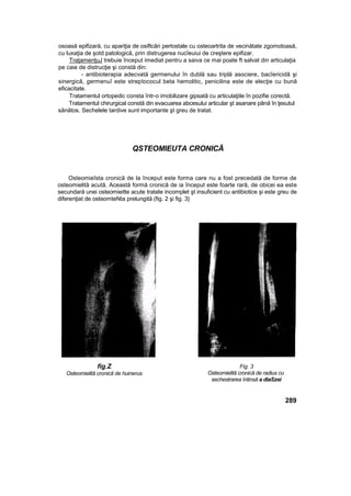 osoasă epifizară, cu apariţia de osiftcâri pertostale cu osteoartrita de vecinătate zgomotoasă,
cu luxaţia de şotd patologică, prin distrugerea nucîeuiui de creştere epifizar.
TraţamenţuJ trebuie început imediat pentru a saiva ce mai poate ft salvat din articulaţia
pe caie de distrucţie şi constă din:
- antibioterapia adecvată germenului în dublă sau triplă asociere, bacîericidâ şi
sinergică, germenuî este streptococul beta hemolitic, penicilina este de elecţie cu bună
eficacitate.
Tratamentul ortopedic consta într-o imobilizare gipsată cu articulaţiile în pozifie corectă.
Tratamentul chirurgical constă din evacuarea abcesului articular şt asanare până în ţesutul
sănătos. Sechelele tardive sunt importante şt greu de tratat.
QSTEOMIEUTA CRONICĂ
Osteomieîsta cronică de la început este forma care nu a fost precedată de forme de
osteomielită acută. Această formă cronică de ia început este foarte rară, de obicei ea este
secundară unei osteomieitte acute tratate incomplet şt insuficient cu antibiotice şi este greu de
diferenţiat de osteomteNta prelungită (fig. 2 şi fig. 3}
fig.Z
Osteomielită cronică de huinerus
Fig. 3
Osteomielită cronică de radius cu
sechestrarea întinsă a diaSzei
289
 