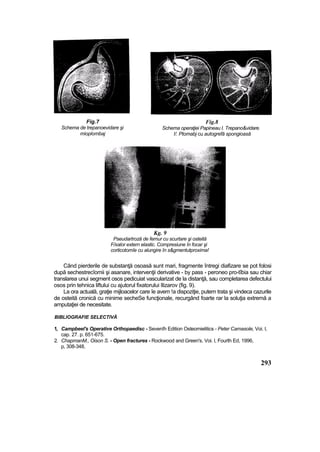 Fig.7
Schema de trepanoevidare şi
mioplombaj
Fig.8
Schema operaţiei Papineau I. Trepano&vidare.
!/. Ptomabj cu autogrefă spongioasă
Kg. 9
Pseudartroză de femur cu scurtare şi osteită
F/xalor extern elastic. Compresiune în focar şi
corticotomîe cu alungire în s&gmentutproxima!
Când pierderile de substanţă osoasă sunt mari, fragmente întregi diafizare se pot folosi
după sechestrecîomii şi asanare, intervenţii derivative - by pass - peroneo pro-tîbia sau chiar
translarea unui segment osos pedicuiat vascularizat de la distanţă, sau completarea defectului
osos prin tehnica liftului cu ajutorul fixatorului Ilizarov (fig. 9).
La ora actuală, graţie mijloacelor care îe avem !a dispoziţie, putem trata şi vindeca cazurile
de osteită cronică cu minime secheSe funcţionale, recurgând foarte rar la soluţia extremă a
amputaţiei de necesitate.
BIBLIOGRAFIE SELECTIVĂ
1, Campbeel's Operative Orthopaedisc - Sevenîh Edition Osteomielitics - Peter Camasole, Voi. l,
cap. 27. p. 651-675.
2. ChapmanM., Oison S. - Open fractures - Rockwood and Green's. Voi. l, Fourth Ed, 1996,
p, 308-348,
293
 