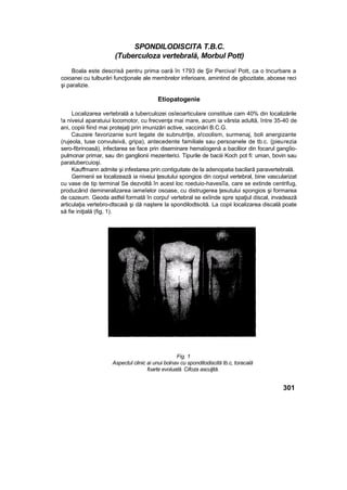 SPONDILODISCITA T.B.C.
(Tuberculoza vertebrală, Morbul Pott)
Boala este descrisă pentru prima oară în 1793 de Şir Perciva! Pott, ca o tncurbare a
coioanei cu tulburări funcţionale ale membrelor inferioare, amintind de gibozitate, abcese reci
şi paralizie.
Etiopatogenie
Localizarea vertebrală a tuberculozei osîeoarticulare constituie cam 40% din localizările
!a niveiul aparatuiui locomotor, cu frecvenţa mai mare, acum ia vârsta adultă, între 35-40 de
ani, copiii fiind mai protejaţi prin imunizări active, vaccinări B.C.G.
Cauzeie favorizanie sunt legate de subnutriţie, a!coolism, surmenaj, boli anergizante
(rujeola, tuse convulsivă, gripa), antecedente familiale sau persoanele de tb.c. {pieurezia
sero-fibrinoasă), infectarea se face prin diseminare hemaîogenă a baciliior din focarul gangîio-
pulmonar primar, sau din ganglionii mezenterici. Tipurile de baciii Koch pot fi: uman, bovin sau
paratubercuioşi.
Kauffmann admite şi infestarea prin contiguitate de la adenopatia bacilară paravertebrală.
Germenii se localizează ia niveiui ţesutului spongios din corpul vertebral, bine vascularizat
cu vase de tip terminal Se dezvoltă în acest loc roeduio-havesîîa, care se extinde centrifug,
producând demineralizarea iameîelor osoase, cu distrugerea ţesutului spongios şi formarea
de cazeum. Geoda astfel formată în corpu! vertebral se exîinde spre spaţiul discal, invadează
articulaţia vertebro-dtscaiă şi dă naştere la spondilodtscită. La copii localizarea discală poate
să fie iniţială (fig, 1).
301
Fig. 1
Aspectul clinic ai unui bolnav cu sponditodiscită tb.c, toracală
foarte evoluată. Cifoza ascuţită.
 