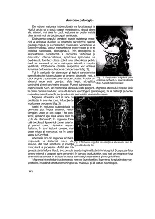 Anatomie patologica
De obicei leziunea tuberculoasă se localizează la
niveîul unuia sa a două corpuri vertebrale cu discul dintre
ele, aiterori, mai ales la copil, ieztunea se poate instala
chiar ia mai mult de două corpuri vertebrale.
Distrugerea corpului vertebral scade rezistenţa meca-
nică a acestuia, ducând la deformări cuneiforme datorită
greutăţii corpului şi a contracturi) musculare. Vertebrele se
cuneiforrnizează, discu! intervertebral este invadat şi ei de
procesul tuberculos, distrugandu-i. Prin distrugerea şi
sechestrarea cuneiformă a corpurilor vertebrali şi
discurilor intervertebraie, apofizele spinoase se
depărtează, formând cifoza potică sau cifoscolioza potică,
dacă se asociază şi cu o distrugere iateraiă a corpilor
vertebrali, întotdeauna ctfozele respective vor antrena
formarea de lordoze subiacente compensatorii (fig. 2),
Tot în perioada de stare apar şi leziuni caracteristice
spondîlodiscitei tuberculoase şt anume abcesele reci, a
căror origine o constituie caverna tuberculoasă. Puroiul din
abcesui rece este grunjos, slab legat, aib-gălbui,
conţinând şi mici sechestre osoase. Puroiui tuberculos
conţine bacilii Koch, iar membrana abcesului este piogenă. Migrarea abcesului rece se face
fie către canalul medular, unde dă leziuni neurologice (parapiegie), fie la distanţă pe tecile
musculare sau structurile conjunctive aie pachetelor vascuiortervoase.
Migrarea abceselor rect se face cu
predilecţie în anumite zone, în funcţie de
localizarea procesului (ftg. 3}
Astfei In regiunea suboccipitaîă şt
cervicală pot migra anterior, retro-
faringian unde se pot paipa - fte pos-
terior, apărând aşa zisul abces rece tn
„cuib de rândunică", în regiunea tora-
cală decolează ligamentul comun anterior
şi pianul osos, căpătând aspect
fusiform, în jurul leziunii osoase, mai
poate migra şi intercostal, rar în patru-
laterul iui Grynfeld.
Abcesele reci din regiunea lombară
migrează ia distanţă mare de
leziune, dat fiind siructurie şt inserţia
musculară a psoasului. Astfel ele mi-
grează până în fosa iîiacă, trec pe sub arcada inghinală până fn triunghiul Scarpa, pe faţa
aniero-internă a coapsei spre genunchi, în canalul adductortior, sau mat pot migra pe faţa
anterioară a sacrului în incizura sciatică sau în regiunea fesieră şi triunghiul Petit.
Migrarea intrarahidiană a abecesuiui rece se face decolând ligamentul longitudinal comun
posterior, invadând structurile meningee sau măduva, şi dă ieztuni neurologice.
302
Fig. 2 Secţiunea sagitaiă prin
coloana lombară cu spondilodiscita
tb.c. Aspect macroscopic
Fig, 3 Schema migrării de etecţîe a abceselor reci în
spondilodiscita tb.c.
 