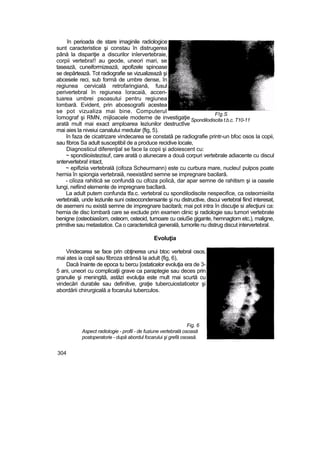 în perioada de stare imaginile radiologice
sunt caracteristice şi constau în distrugerea
până la dispariţie a discurilor inîervertebraie,
corpii vertebra!! au geode, uneori mari, se
tasează, cuneiformizează, apofizele spinoase
se depărtează. Tot radiografie se vizualizează şi
abcesele reci, sub formă de umbre dense, în
regiunea cervicală retrofaringiană, fusul
perivertebral în regiunea îoracaiă, accen-
tuarea umbrei psoasutui pentru regiunea
lombară. Evident, prin abcesografii acestea
se pot vizualiza mai bine. Computerul
îomograf şi RMN, mijloacele moderne de investigaţie
arată mult mai exact amploarea leziunilor destructîve
mai aies la niveiui canalului medular {fig, 5).
în faza de cicatrizare vindecarea se constată pe radiografie printr-un bfoc osos la copii,
sau fibros Sa adult susceptibil de a produce recidive locale,
Diagnosticul diferenţial se face la copii şi adoiescent cu:
~ spondiioiistezisuf, care arată o alunecare a două corpuri vertebrale adiacente cu discul
sntervertebra! intact,
~ epifiziia vertebrală (cifoza Scheurmann) este cu curbura mare, nucleu! pulpos poate
hernia în spiongia vertebraiă, neexistând semne se impregnare bacilară.
- ciîoza rahitică se confundă cu cifoza poîică, dar apar semne de rahitism şi ia oasele
lungi, nefiind elemente de impregnare bacîlară.
La adult putem confunda tfa.c. vertebral cu spondilodiscite nespecifice, ca osteomieiita
vertebrală, unde leziunile suni osteocondensante şi nu distructive, discui vertebral fiind interesat,
de asemeni nu există semne de impregnare bacitară; mai pot intra în discuţie si afecţiuni ca:
hernia de disc lombară care se exclude prin examen clinic şi radiologie sau tumori vertebrate
benigne (osteobiasîom, osteom, osteoid, tumoare cu ceiuSe gigante, hemnagtom etc.), maligne,
primitive sau metastatice. Ca o caracteristică generală, tumorile nu distrug discut intervertebral.
Evoluţia
Vindecarea se face prin obţinerea unui btoc vertebral osos,
mai ates ia copil sau fibroza strânsă la adult {fig, 6),
Dacă înainte de epoca tu bercu [ostaticelor evoluţia era de 3-
5 ani, uneori cu complicaţii grave ca paraptegie sau deces prin
granulie şi meningită, astăzi evoluţia este mult mai scurtă cu
vindecări durabile sau definitive, graţie tubercuiostaticetor şi
abordării chirurgicală a focarului tuberculos.
Fig. 6
Aspect radiologie - profil - de fuziune vertebrală osoasă
postoperatorie - după abordul focarului şi grefă osoasă.
304
F!g.S
Spondilodiscita t.b.c. T10-11
 