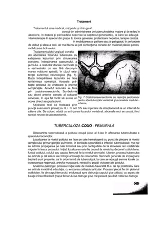 Tratament
Tratamentul este medical, ortopedic şi chirugica!.
constă din administrarea de tubercufostatice majore şi de reJeu în
asociere, în dozele şi perioadele descrise la capitolul generalităţi, la care se adaugă
vitamioterapie în special din grupul 8, tonice generale, protectoare hepatice, terapie caicică.
in imobilizarea pe pat tare sau pe pat gipsat, în perioadele
de debut şi stare a bolii, iar mai târziu se pot confecţiona corsete din material plastic pentru
mobilizarea bolnavului.
Tratamentulchirurgical constă
din abordarea focarului tuberculos cu
extirparea leziunilor prin chiuretarea
acestora, îndepărtarea cazeumului, a
puroiului, a resturilor discaie necrozate şi
a sechestrelor cu sau fără decompri-
marea măduvei spinală, în căzu! exis-
tenţei suferinţei neurologice {fig. 7).
După îndepărtarea leziunilor se face
rahisinteza somatică. Aceasta gră-
beşte procesul de vindecare şi previne
complicaţiile. Abordu! leziunilor se face
prin costotransverectomîe, Somboîomie
sau abord anterior somatic aî coloanei
cervicale, în aşa fel încât să existe un
acces direct asupra leziunii.
Abcesele reci se tratează prin
puncţii evacuatorii şi lava] cu H, i. N. sol. 5% sau injectare de streptomicină ia un interval de
câteva zile. De obicei, odată cu extirparea focarulut vertebral, abcesele reci se usucă, fiind
rareori nevoie de abcesectomie,
TUBERCULOZA COXO - FEMURALĂ
Osteoartrita tuberculoasă a şoidului ocupă (ocuî al îl-iea în afectarea tuberculoasă a
aparatului locomotor.
Localizarea la nivelul şoldului se face pe cale hematogenă cu punct de plecare ia nivelui
complexului primar ganglio-puimonar, în perioada secundară a infecţiei tuberculoase; mat rar
se admite propagarea pe cale limfatică sau prin contiguitate de ta abcesele reci vertebrale
migrate în teaca psoasului. Iniţial, localizarea este fie osoasă la nivelul sprâncene! cotitoîdtene,
fundul cotiluiui, coiului sau capuiui femural fie la nivelul sinoviaîei. Ulterior, procesul tuberculos
se extinde şi dă leziuni aie întregii articulaţii de osteoartriiă. Semnefe generale de impregnare
bacilară sunt prezente, ca în orice formă de tuberculoză, !a care se adaugă semne locale ca:
osteoporoza regională, artrofia musculară, retractii şi poziţii vicioase ale şoidului.
Anatomo-patoîogic, procesul iniţial este de medulo-haversîtă tb.c. de tip proliferativ care
se extinde invadând articuîaţia, cu erodarea cattiajului articular. Procesul plecat fie din plafonul
cotiloidian, fie din capul femurului, evoluează spre distrucţia capuiui şi a cotiluiui, cu aspect de
luxaţie inîracotîloidiană {capul femurului se distruge şi se micşorează pe când cotilul se distruge
Fig. 7 Costotransversectomie cu rezecţia pedicutului
pentru abordul corpilor vertebrali şi a canalului medular -
schema.
 