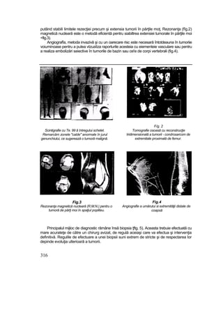 putând stabili limitele rezecţiei precum şi extensia tumorii în părţile moţ. Rezonanţa (fîg.2)
magnetică nucleară este o metodă eficientă pentru siabiltrea extensiei tumorale In părţile moi
<fig.3).
Angiografîa, metoda invazivâ şi cu un oarecare risc este necesară întotdeauna în tumoriie
voiuminoase pentru a putea vtzuaîiza raporturile acesteia cu eiementeie vasculare sau pentru
a realiza embolizări seiective în tumorile de bazin sau ce!e de corpi vertebrali (fig.4).
Scintigrafie cu Te. 99 â întregului schelet.
Remarcăm zonele "calde" anormale în jurul
genunchiului, ce sugerează o tumoră malignă.
F/g. 2
Tomografie osoasă cu reconstrucţie
tridimensională a tumorii - condrosarcom de
extremitate proximală de femur.
Fig.3
Rezonanţa magnetică nucleară (R.M.N.) pentru o
tumoră de părţi moi în spaţiul popliteu.
Fig.4
Angiografie a umărului si extremităţii distale de
coapsă
Principalul mijloc de diagnostic rămâne însă biopsia ţftg. 5), Aceasta trebuie efectuată cu
mare acurateţe de către un chirurg avizat, de regulă aceiaşi care va efectua şi intervenţia
definitivă. Regulile de efectuare a unei biopsii suni extrem de stricte şi de respectarea lor
depinde evoluţia ulterioară a tumorii.
316
 