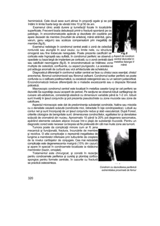 hemimieiică. Cele două sexe sunt atinse în proporţii egale şi se pot
întâlni în limite foarte largi de vârstă între 10 şt 50 de ani.
Examenul clinic arată durere şi tumefacţiî focale în localizările
superficiale. Frecvent boaîa debutează printr-o fractură spontană pe os
patologic, în encondromatozele apărute şi dezoltate din copilărie pot
apare dezaxări de membre (încurbări de antebraţ, mână strâmbă, genu
varum, genu valgum) sau scolioze compensatorii prin inegalităţi de
membre (fig.8),
Examenui radiologie în condromul central arată o zonă de osîeoîiză
rontundă sau aiungită în axul osului, cu limite nete, cu structura
omogenă sau fine trabecule neregulate. Poate prezenta caiclficărt iar
corticala este îngroşată sau suflată, în condromut periferic se observă o
opacitate cu baza largă de implantare pe corticaiă, cu o zonă centrală clară
sau calcificări neomogene (fig.9). In encondromatoză se întâlnesc zone
multiple de osteoliză, confluente, cu aspect piurigeodic. La acestea se
pot adăuga anomalii de curbură sau vicii arhitecturale ale scheletului.
Diagnosticul diferenţial în conîromul solitar centrat se face cu chistui osos esenţial, chistu!
anevrismai, fibromul condromixoid sau fibromul osifsant. Condromul soittar periferic se poate
confunda cu o osificare posttraumatică, cu exostoză osteogenică sau cu un sarcom juxtacortical.
Encondromatoză trebuie diferenţiată de o maladie exostozantă sau o dispiazie fibroasă
poliostică.
Macroscopic condromul centra! este localizat în metafiza oaselor lungi iar cel periferic se
dezvoltă Sa suprafaţa osuiui acoperit de periost. Pe secţtune se observă lobuli carttlaginoşi de
cuioare aib-aibăstruie, consistenţă elastică cu dimensiuni variabile până la 1-2 cm. tobuiii
sunt înveliţi în ţesut conjunctiv şi pot prezenta pseudochiste cu zone mucoide sau zone de
calcificare.
Aspectul microscopic este dat de predominenţa substanţei condroide, hialina sau mixoida
cu o densitate ceiulară scăzută (condrocite mici, retractate în loje condropiastice). Lobulii au
contur net şi sunt înconjuraţi de un ţesut conjunctiv redus şi slab vascularizat. După Foresî,
criteriile citoiogice de benignitate sunt: dimensiunea condrocîtelor, egalitatea lor şi densitatea
scăzută de cromatină din nucieu. Aproximativ 10 până !a 20% pot degenera sarcomatos,
apărând elemente celulare atipice inciuse într-o plajă de substanţă mucoidă. Pentru un
diagnostic corect este necesar ca biopsia să fie prelevată din cât mai muite zone aie tumorii.
Tumora poate da complicaţii minore cum ar ft: jena
mecanică şi funcţională, fractura, încurcările de membre
şi recidiva. O alta compitcaţie o reprezintă inegalitatea de
lungime a membrelor inferioare prin tulburările de creştere
de la nivelui cartilajelor de conjugare. Cea mai redutabilă
complicaţie este degenerescenta maiignă (15% din cazuri)
şi apare în special în condroamele localizate ia rădăcina
membrelor (bazin, omoplat).
Tratamentul este chirurgical, şi constă în rezecţie
pentru condroamele periferice şi cureîaj şi ptombaj cortîco-
spongios pentru formele centrale, în cazurile cu fractură
se practică osteosinteza. ... „
Condrom cu dezvoltarea periferică
extremitatea proximaiă de femur
320
Flg.8
Aspect de condrom
central dezvoltat în
metafiza falangei II
mână.
 