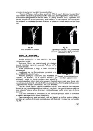 anevrismuî sau tumora brună din hiperperotiroidism.
Tratamentul- fractura poate vindeca aproximativ 15% din cazuri, chiuretajul plus plombaju!
este indicat în faza de invoiuţie a chistului, altfel recidivează. Se mai poate face puncţia chistului,
evacuarea Iu: şi injectarea de cortizoni retard, 2-3 puncţiî la interval de 3-4 săptămâni. Mai
recent, se practică şi puncţia chistului, evacuarea lui şi injectarea de măduvă osoasă
hernatogenă recoltată exiemporaneu. Fractura se tratează ortopedic sau chirurgicaî după
caz.
Fig, 11
Chist osos solitar de humerus
Fig. 12
Fractură pe os patologic - chist osos esenţial
de femur. Trepartoevidare, grefă spongioasă,
osteosinteză cu D. H. S.
DISPLAZIA FIBROASĂ
Forma monosttcă a fost descrisă de Jaffe-
Lîchstenstein în 1937.
Sindromu! Albright se caracterizează prin displazie
osoasă poliostică, pigmentare cutanată "cafe au !ait" şi
pubertate precoce.
Apare predominant ia fetiţe, ia vârsta copilăriei şi
adolescenţei.
Localizarea cea mai frecventă este pe oasele lungi:
femur (90%), tibie, coaste, bazin,
Anatomia patologică- Localizarea este metafizarâ sau
diafizară, rar epifizară, cu o structură fibroasă, gri-
albicioasă, uneori cu insule cartilaginoase, alteori cu
remanieri vasculare, edem şi zone hemoragice. Histoiogic se constată ţesut fibros, puţin
vascularizat, cu substanţă osteoidă fără lizereu osteobiastic, alteori cu plaje cartiiaginoase.
Degenerescenta malignă sarcomatoasă în 0,5-3% din cazuri.
Clinic •• cazurile prezintă o simptomatologie dureroasă şi/sau incurbări diafizare {tibie,
femur), Se mai constată inegalităţi de iungime a membrelor, genu-varum sau genu-valgus,
pete cutanate "cafe au laif de dimensiuni mici localizate pe ceafă, umeri, fese - In forma
poliostică.
Tulburările endocrine se caracterizează prin pubertate precoce, alteori cu o creştere
accelerată neomogenă care poate da inegalităţi.
Examenul radiologie- arată o localizare meta sau diafizară rar eptfizar, centro-medular cu
extindere spre periferie, fără reacţie periostală, cu o delimitare neîă între leziune şi osul sănătos
<fig. 13)
323
Fig.13
Disptazie fibroasă diafizară femur,
aspect pre - şipostoperator.
 