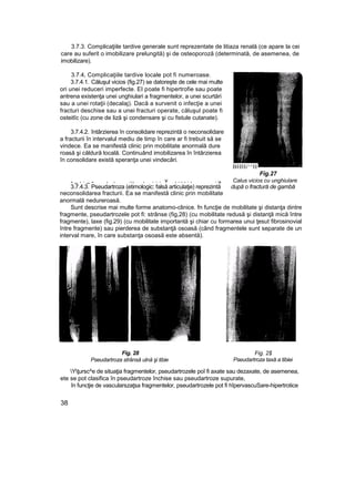 3.7.3. Complicaţiile tardive generale sunt reprezentate de litiaza renală (ce apare la cei
care au suferit o imobilizare prelungită) şi de osteoporoză (determinată, de asemenea, de
imobilizare).
3.7.4, Complicaţiile tardive locale pot fi numeroase.
3.7.4.1. Căluşul vicios (fig.27) se datoreşte de cele mai multe
ori unei reduceri imperfecte. EI poate fi hipertrofie sau poate
antrena existenţa unei unghiulari a fragmentelor, a unei scurtări
sau a unei rotaţii (decalaj). Dacă a survenit o infecţie a unei
fracturi deschise sau a unei fracturi operate, căluşul poate fi
osteitîc (cu zone de liză şi condensare şi cu fistule cutanate).
3.7.4.2. întârzierea în consolidare reprezintă o neconsolidare
a fracturii în intervalul mediu de timp în care ar fi trebuit să se
vindece. Ea se manifestă clinic prin mobilitate anormală dure
roasă şi căldură locală. Continuând imobilizarea în întârzierea
în consolidare există speranţa unei vindecări.
BHHi^^H
Fig.27
„ _ , . _ „ , , .,, , . . . v , . , , . , . ia Calus vicios cu unghiulare
3.7.4.3. Pseudartroza (etimologic: falsă articulatje) reprezintă după o fractură de gambă
neconsolidarea fracturii. Ea se manifestă clinic prin mobilitate
anormală nedureroasă.
Sunt descrise mai multe forme anatomo-clinice. fn funcţie de mobilitate şi distanţa dintre
fragmente, pseudartrozele pot fi: strânse (fig,28) (cu mobilitate redusă şi distanţă mică între
fragmente), laxe (fig.29) (cu mobilitate importantă şi chiar cu formarea unui ţesut fibrosinovial
între fragmente) sau pierderea de substanţă osoasă (când fragmentele sunt separate de un
interval mare, în care substanţa osoasă este absentă).
Fig. 28
Pseudartroza strânsă ulnă şi tibie
Fig. 2$
Pseudartroza taxă a tibiei
Yţursc^e de situaţia fragmentelor, pseudartrozele poî fi axate sau dezaxate, de asemenea,
ete se pot clasifica în pseudartroze închise sau pseudartroze supurate,
în funcţie de vascularszaţsa fragmentelor, pseudartrozele pot fi hîpervascuSare-hipertrotice
38
 
