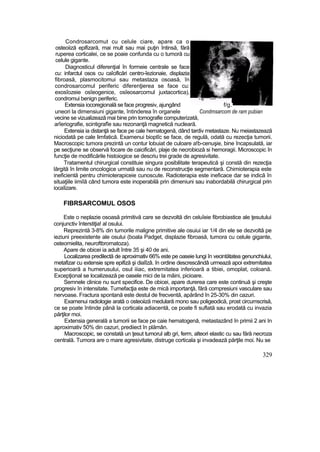 Condrosarcomut cu celule ciare, apare ca o
osteoiiză epifizară, mai mult sau mai puţin întinsă, fără
ruperea corticalei, ce se poaie confunda cu o tumoră cu
celule gigante.
Diagnosticul diferenţial în formeie centrale se face
cu: infarctul osos cu caîcificări centro-îezionaie, displazia
fibroasă, plasmocitomui sau metastaza osoasă, în
condrosarcomul periferic diferenţierea se face cu:
exosîozeie osîeogenice, osîeosarcomul juxtacortica),
condromui benign periferic. -s^^—™^^^
Extensia iocoregională se face progresiv, ajungând f/g.
uneori la dimensiuni gigante, întinderea în organele Condmsarcom de ram pubian
vecine se vizualizează mai bine prin tomografie computerizată,
arîeriografie, scintigrafîe sau rezonanţă magnetică nucleară.
Extensia ia distanţă se face pe cale hematogenă, dând tardiv metastaze. Nu meiastazează
niciodată pe cale limfatică. Examenui bioptîc se face, de regulă, odată cu rezecţia tumorii.
Macroscopic tumora prezintă un contur lobuiat de culoare a!b-cenuşie, bine încapsulată, iar
pe secţiune se observă focare de caicificări, plaje de necrobioză si hemoragii. Microscopic în
funcţie de modificările histoiogice se descriu trei grade de agresivitate.
Tratamentul chirurgical constituie singura posibilitate terapeutică şi constă din rezecţia
lărgită în limite oncologice urmată sau nu de reconstrucţie segmentară. Chimioterapia este
ineficientă pentru chimioterapiceie cunoscute. Radioterapia este ineficace dar se indică în
situaţiile iimiîă când tumora este inoperabilă prin dimeniuni sau inabordabilă chirurgical prin
iocaîizare.
FIBRSARCOMUL OSOS
Este o neplazie osoasă primitivă care se dezvoltă din celuîeie fibrobiastice ale ţesutului
conjunctiv înterstiţia! al osului.
Reprezintă 3-8% din tumorile maligne primitive ale osuiui iar 1/4 din ele se dezvoltă pe
ieziuni preexistente ale osului (boala Padget, displazie fibroasă, tumora cu celule gigante,
osteomielita, neuroftbrornatoza).
Apare de obicei ia adult între 35 şi 40 de ani.
Localizarea predilectă de aproximativ 66% este pe oaseie lungi în vecintătatea genunchiului,
metafizar cu extensie spre epifiză şi diaîîzâ. în ordine descrescândâ urmează apoi extremitatea
superioară a humerusului, osul iiiac, extremitatea inferioară a tibiei, omoplat, coloană.
Excepţional se localizează pe oasele mici de la mâini, picioare.
Semnele clinice nu sunt specifice. De obicei, apare durerea care este continuă şi creşte
progresiv în intensitate. Tumefacţia este de mică importanţă, fără compresiuni vasculare sau
nervoase. Fractura spontană este destul de frecventă, apărând în 25-30% din cazuri.
Examenui radiologie arată o osteoiiză medulară mono sau poligeodică, prost circumscrisă,
ce se poate întinde până la corticala adiacentă, ce poate fi suflată sau erodată cu invazia
părţilor moi.
Extensia generală a tumorii se face pe caie hematogenă, metastazând în primii 2 ani In
aproximativ 50% din cazuri, prediiect în plămân.
Macroscopic, se constată un ţesut tumorul alb gri, ferm, alteori elastic cu sau fără necroza
centrală. Tumora are o mare agresivitate, distruge corticala şi invadează părţile moi. Nu se
329
 