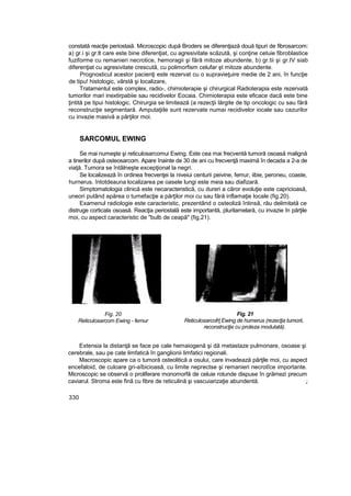constată reacţie periostaiă. Microscopic după Broders se diferenţiază două tipuri de fibrosarcom:
a) gr.i şi gr.lt care este bine diferenţiat, cu agresivitate scăzută, şi conţine cetuie fibroblastice
fuziforme cu remanieri necrotice, hemoragii şi fără mitoze abundente, b) gr.tii şi gr.IV siab
diferenţiat cu agresivitate crescută, cu polimorfism celufar şt mitoze abundente.
Prognosticul acestor pacienţi este rezervat cu o supravieţuire medie de 2 ani, în funcţie
de tipu! histologic, vârstă şi localizare,
Tratamentul este complex, radio-, chimioterapie şi chirurgical Radioterapia este rezervată
tumorilor mari inextirpabiie sau recidivelor Eocaia. Chimioterapia este eficace dacă este bine
ţintită pe tipui histologic. Chirurgia se limitează (a rezecţii lărgite de tip oncologic cu sau fără
reconstrucţie segmentară. Amputaţiile sunt rezervate numai recidivelor iocale sau cazurilor
cu invazie masivă a părţilor moi.
SARCOMUL EWING
Se mai numeşte şi reticulosarcomui Ewing. Este cea mai frecventă tumoră osoasă malignă
a tinerilor după osteosarcom. Apare înainte de 30 de ani cu frecvenţă maximă în decada a 2-a de
viaţă. Tumora se întâlneşte excepţional la negri.
Se localizează în ordinea frecvenţei la niveiui centurii peivine, femur, iibie, peroneu, coaste,
hurnerus. întotdeauna localizarea pe oasele lungi este meia sau diafizară.
Simptomatologia clinică este necaracteristică, cu dureri a căror evoluţie este capricioasă,
uneori putând apărea o tumefacţie a părţilor moi cu sau fără inflamaţie locale (fig.20).
Examenul radiologie este caracteristic, prezentând o osteoliză întinsă, rău delimitată ce
distruge corticala osoasă. Reacţia periostală este importantă, plurilamelară, cu invazie în părţile
moi, cu aspect caracteristic de "bulb de ceapă" (fig,21).
Fig. 20
Reticulosarcom Ewing - femur
Fig. 21
Reticulosarcofrţ Ewing de humerus (rezecţia tumorii,
reconstrucţie cu proteza modulată).
Extensia la distanţă se face pe cale hemaiogenă şi dă metastaze pulmonare, osoase şi
cerebrale, sau pe cate limfatică în ganglionii limfatici regionali.
Macroscopic apare ca o tumoră osteolitică a osului, care invadează părţile moi, cu aspect
encefaloid, de culoare gri-aîbicioasă, cu limite neprectse şi remanieri necrotîce importante.
Microscopic se observă o proliferare monomorfă de celuie rotunde dispuse în grămezi precum
caviarul. Stroma este fină cu fibre de reticulină şi vascuiarizaţie abundentă. ,:
330
 