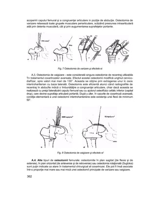 acoperirii capului femural şi a congruenţei articulare in poziţie de abducţie. Osteotomia de
varizare relaxează toate grupele musculare periarticulare, scăzând presiunea intraarttculară
atât prin detenta musculară, cât şi prin augumentarea suprafeţelor portante.
Fig, 7 Osteotomia da varizare şi efectele ei
A,3, Osteotomia de vaigizare - este considerată singura osteolomie de recentraj utilizabila
Tn tratamentul coxartrozelor avansate. Efectul acestei osteotomii modifică unghiul cervico-
diafîzar, spre valori mai mari de 130°. Aceasta se obţine prin extragerea unui Ic osos
intertrohartterian cu baza laterală. Osteotomis este eficientă atunci când radiografiile de
recentraj în abducfie indică o îmbunătăţire a congruenţei articulare, chiar dacă aceasta se
realizează cu preţul lateralizării capului femural sau cu ajutorul osteofiîului cefalic inferior (capital
drop), care devine suprafaţa articulară portantă. După y uller, în cazurile de coxartroză avansată,
condiţia elementară a unei osteotomii intertrohanteriene este existenţa unei flexii de minimum
50°.
Fig, 8 Osteotomia de vaigizare şi efectele ei'
A.4. Alte tipuri de osteotomii femurale: osteotomiile în plan sagitat {de flexie şi de
extensie), în pian orizontal (de anteversie şi de retroversie) sau osteotomia rotaţională (Sugîoka)
sunt puţin indicate ca atare în tratamentul chirurgical al coxartrozei. Ele pot fi Insă asociate
într-o proporţie mai mare sau mai mică unei osteotomiî principale de varizare sau vaigizare.
362
 