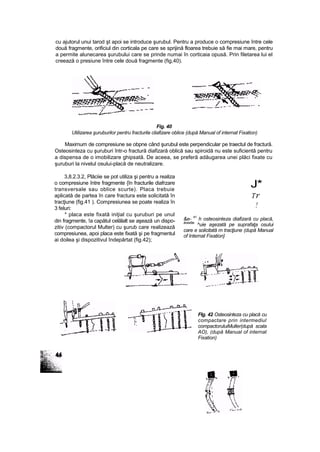 cu ajutorul unui tarod şt apoi se introduce şurubul. Pentru a produce o compresiune între cele
două fragmente, orificiul din corticala pe care se sprijină floarea trebuie să fie mai mare, pentru
a permite alunecarea şurubului care se prinde numai în corticaia opusă. Prin filetarea lui el
creează o presiune între cele două fragmente (fig,40).
Fig. 40
Utilizarea şuruburilor pentru fracturile cliafizare oblice (după Manual of internat Fixation)
Maximum de compresiune se obpne când şurubul este perpendicular pe traectul de fractură.
Osteosinteza cu şuruburi într-o fractură diafizară oblică sau spiroidă nu este suficientă pentru
a dispensa de o imobilizare ghipsată. De aceea, se preferă adăugarea unei plăci fixate cu
şuruburi la nivelul osului-placă de neutralizare.
3,8.2.3.2, Plăciie se pot utiliza şi pentru a realiza
o compresiune între fragmente {în fracturile diafrzare
transversale sau oblice scurte). Placa trebuie
aplicată de partea în care fractura este solicitată în
tracţiune (fig.41 ). Compresiunea se poate realiza în
3 feluri:
* placa este fixată iniţial cu şuruburi pe unul
din fragmente, !a capătul celălalt se aşează un dispo-
zitiv (compactorul Multer) cu şurub care realizează
compresiunea, apoi placa este fixată şi pe fragmentul
ai doilea şi dispozitivul îndepărtat (fig.42);
J*
Tr
!
&e- 41
h osteosinteza diafizară cu placă,
âcea$ta
^uie aşezată pe suprafaţa osului
care e solicitată m tracţiune (după Manual
of Internat Fixation}
Flg. 42 Osteosinteza cu placă cu
compactare prin intermediul
compactoruluiMuller(după scala
AO), (după Manual of internat
Fixation)
 