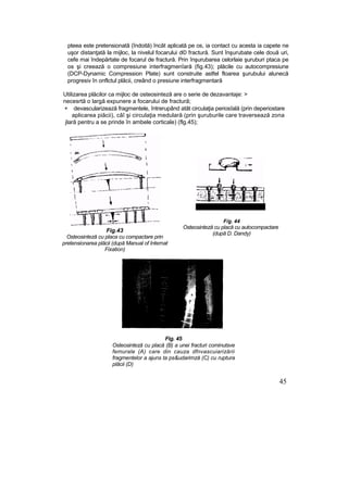 pteea este pretensionatâ (îndoită) încât aplicată pe os, ia contact cu acesta ia capete ne
uşor distanţată la mijloc, la nivelul focarului d© fractură. Sunt înşurubate cele două uri,
cefe mai îndepărtate de focarul de fractură. Prin înşurubarea celorlaie şuruburi ptaca pe
os şi creează o compresiune interfragmenîară (fig.43); plăcile cu autocompresiune
(DCP-Dynamic Compression Plate) sunt construite astfel floarea şurubului alunecă
progresiv în onflctul plăcii, creând o presiune interfragmentară
Utilizarea plăcilor ca mijloc de osteosinteză are o serie de dezavantaje: >
necesrtă o largă expunere a focarului de fractură;
+ devascularizează fragmentele, întrerupând atât circulaţia periosîală (prin deperiostare
aplicarea piăcii), câî şi circulaţia medulară (prin şuruburile care traversează zona
jlară pentru a se prinde în ambele corticale) (flg.45);
Fig.43
Osteosinteză cu placa cu compactare prin
pretensionarea plăcii (după Manual of Internat
Fixation)
F/g. 44
Osteosinteză cu placă cu autocompactare
(după D. Dandy)
Fig. 45
Osteosinteză cu placă (B) a unei fracturi cominutsve
femurale (A) care din cauza dfnvascuiarizării
fragmentelor a ajuns ta ps&udarimză (C) cu ruptura
plăcii (D)
45
 