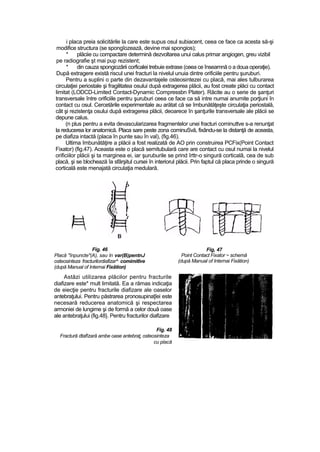 i placa preia solicitările la care este supus osul subiacent, ceea ce face ca acesta să-şi
modifice structura (se spongîozează, devine mai spongios);
* plăciie cu compactare determină dezvoltarea unui calus primar angiogen, greu vizibil
pe radiografie şt mai pup rezistent;
* din cauza spongiozârii corficalei trebuie extrase (ceea ce înseamnă o a doua operaţie).
După extragere există riscul unei fracturi la nivelul unuia dintre orificiile pentru şuruburi.
Pentru a suplini o parte din dezavantajele osteosintezei cu placă, mai ales tulburarea
circulaţiei periostale şi fragilitatea osului după extragerea plăcii, au fost create plăci cu contact
limitat (LODCD-Limited Contact-Dynamic Compressbn Plater). Răcite au o serie de şanţuri
transversale între orificiile pentru şuruburi ceea ce face ca să intre numai anumite porţiuni în
contact cu osul. Cercetările experimentale au arătat că se îmbunătăţeşte circulaţia periostală,
cât şi rezistenţa osului după extragerea plăcii, deoarece în şanţurile transversale ale plăcii se
depune calus.
(n plus pentru a evita devascularizarea fragmentelor unei fracturi cominuttve s-a renunţat
la reducerea lor anatomică. Placa sare peste zona cominuSvă, fixându-se la distanţă de aceasta,
pe diafiza intactă (placa în punte sau în val), (fig.46).
Ultima îmbunătăţire a plăcii a fost realizată de AO prin construirea PCFix(Point Contact
Fixator) (fig.47). Aceasta este o placă semitubulară care are contact cu osul numai la nivelul
orificiilor plăcii şi ta marginea ei, iar şuruburile se prind îrttr-o singură corticalâ, cea de sub
placă, şi se blochează îa sfârşitul cursei în interiorul plăcii. Prin faptul că placa prinde o singură
corticală este menajată circulaţia medulară.
Fig. 46
Placă "înpuncte"(A), sau In var(B)pentnJ
osteosinteza fracturilordiafizar^ comimitîve
(după Manual of Internai Fixâtion)
Astăzi utilizarea plăcilor pentru fracturile
diafizare este* mult limitată. Ea a rămas indicaţia
de eiecţie pentru fracturile diafizare ale oaselor
antebraţului. Pentru păstrarea pronosupinaţîei este
necesară reducerea anatomică şi respectarea
armoniei de lungime şi de formă a celor două oase
ale antebraţului (fig.48}. Pentru fracturilor diafizare
Fig. 48
Fractură dtafîzară ambe oase antebraţ, osteosinteza
cu placă
Fig, 47
Point Contact Fixator ~ schemă
(după Manual of Internai Fixâtion)
 