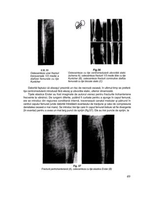 F/ff. 55
Osteosinteza unei fracturi
transversale 1/3 medie a
diafizei femurale cu tije
Kuntcher
Fig.56
Osteosinteza cu tije centromeduiară zăvorâtă static
(schema A), osteosinteza fracturii 1/3 medie tibie cu tije
Kuntcher (B), osteosinteza fracturii cominutive diaftza
femurală cu tije blocate static (C)
Datorită faptului că aîezaju! prezintă un risc de necroză osoasă, în ultimul timp se preferă
tija centromedulară introdusă fără alezaj şi zăvorâta static, ulterior dinamizată.
Tijele elastice Ender au fost imaginate de autorul vienez pentru fracturile trohanteriene
frecvente la vârstnici. De iungsmi diferite, putând fi curbate pentru a ajunge în capul femural,
eie se introduc din regiunea condiliană internă, traversează canalul medular şi pătrund în
centrul capului femural (unde datorită întretăierii evantaiului de tracţiune şi celui de compresiune
densitatea osoasă e mai mare). Se introduc trei tije care în capul femural trebuie să fie divergente
{In evantai) pentru a avea un mai larg punct de sprijin (ftg.57). Ele au trei puncte de sprijin, la
Fig. 57
Fractură pertrohanteriană (A), osteosinteza cu tije elastice Ender (B)
49
 
